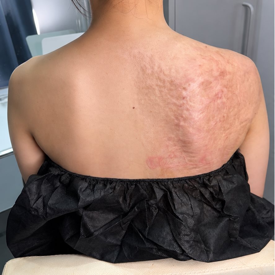흉터 커버 전