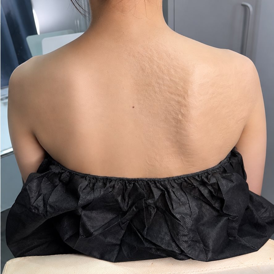 흉터 커버 후